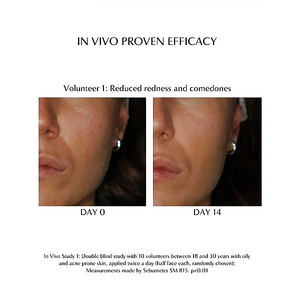 Crema de fata pentru ten acneic acne face cream