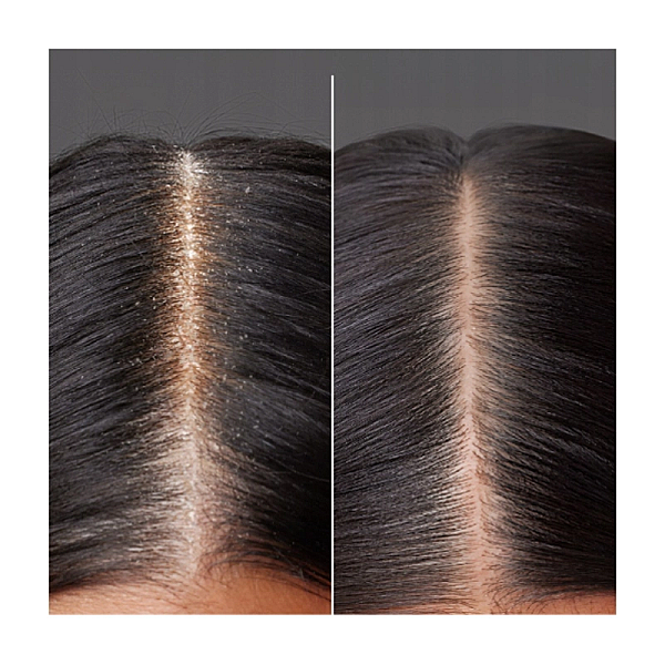 Trio pack pentru problemele scalpului scalp vitality trio foil