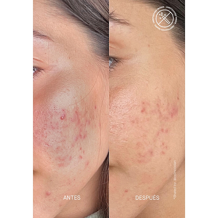 Serum pentru piele reactiva cu 15% Acid Azelaic AZID